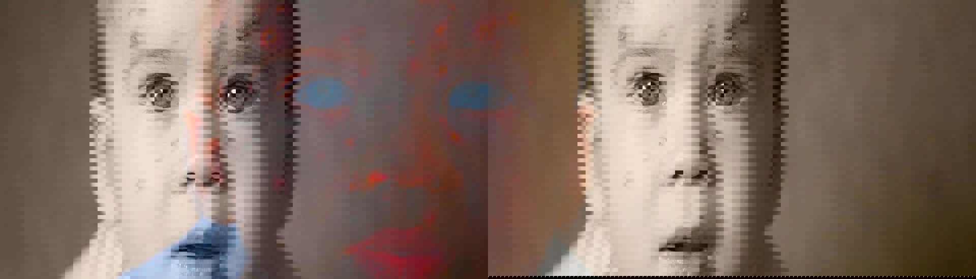 Ziek kindje met windpokken