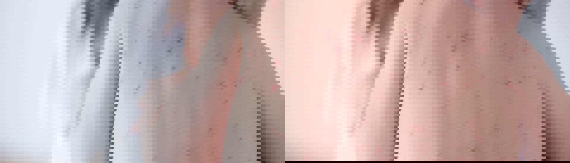 Kind met windpokken: voorkomen en genezen